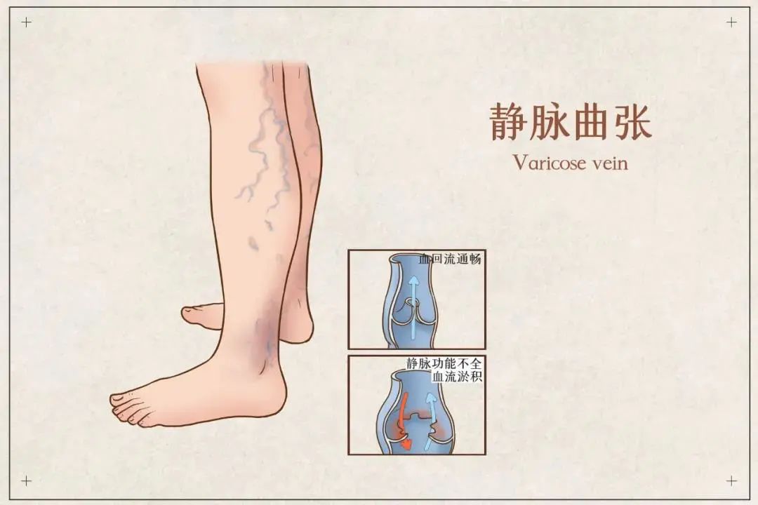 蹺二郎腿真的會導(dǎo)致靜脈曲張嗎？MG動畫制作易懂又直觀第3張圖片