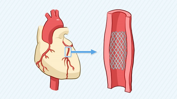 得了冠心病，支架是不是一定要植入？制作醫療科普動畫來了解第1張圖片
